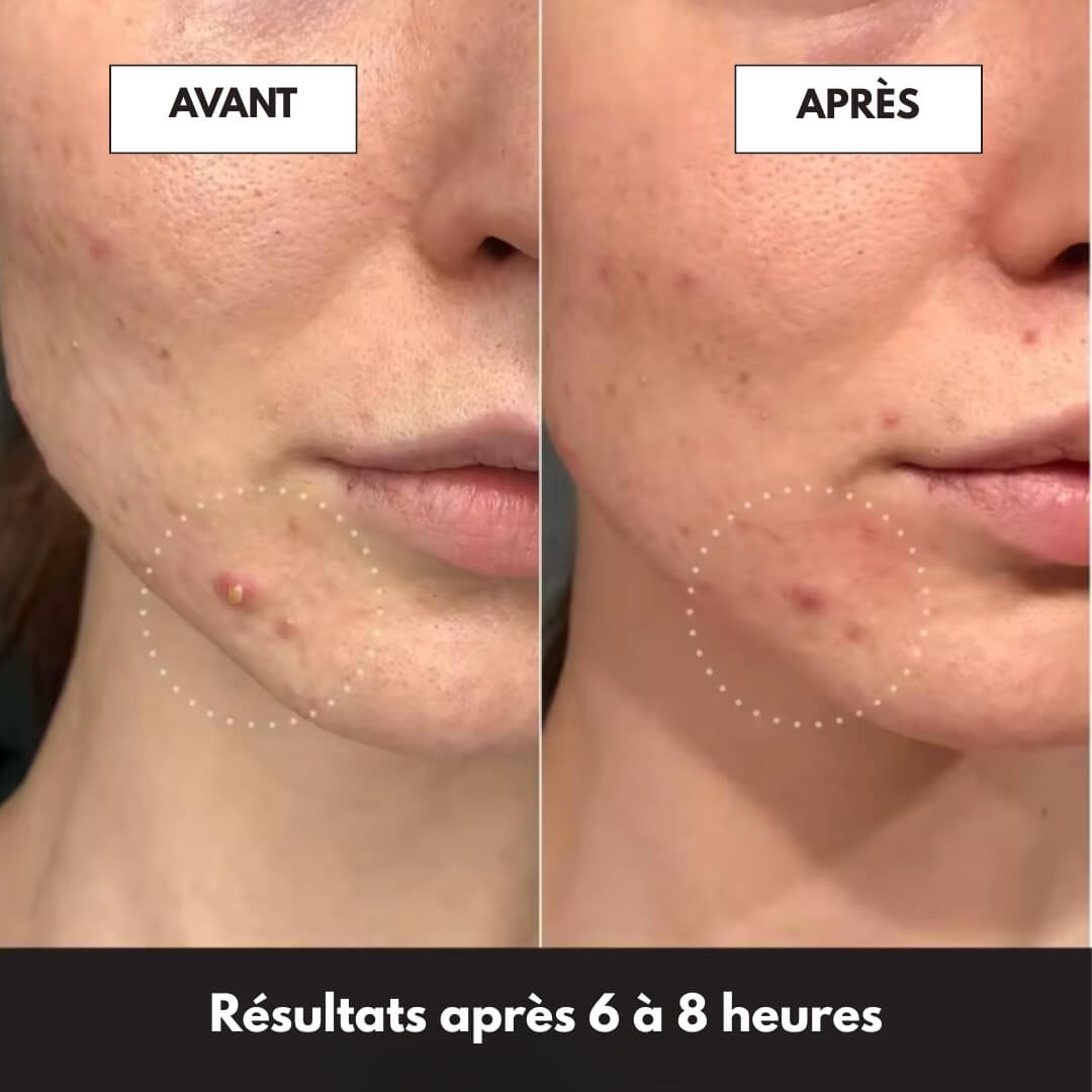 Patchs anti-boutons invisibles – 144 patchs anti-acné professionnels