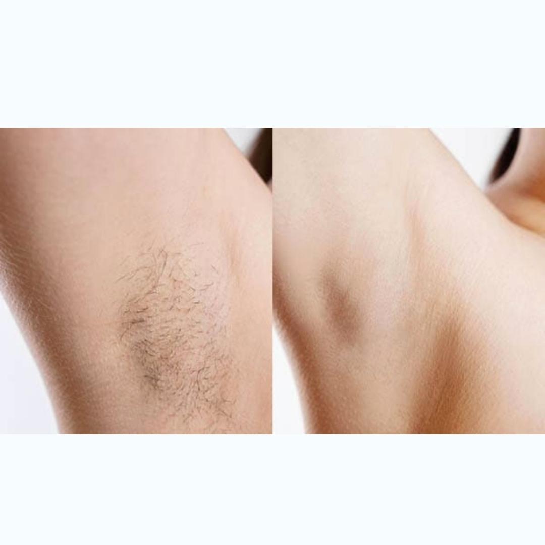 EPIL PRO : L'épilateur pour corps et visage à micro-oscillations