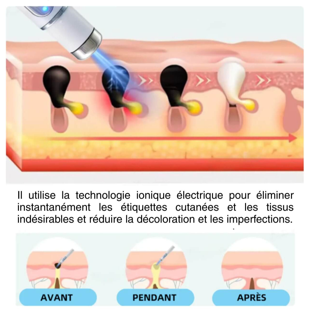 Kidsneed - Stylo Laser non invasif pour l'élimination des grains de beauté et des verrues